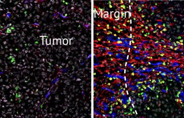 Les cellules stromales en marge de la tumeur © Institut Pasteur