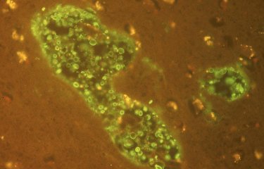 Cryptococcus neoformans dans un abcès du cerveau © Institut Pasteur/Françoise Dromer