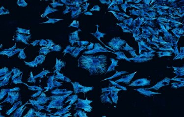 Cellules de glioblastome humain © Institut Pasteur