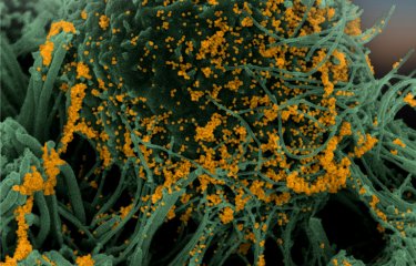 Cellules bronchiques humaines (vert) infectées par SARS-CoV-2 (jaune). Image obtenue par microscopie électronique à balayage puis colorisée.